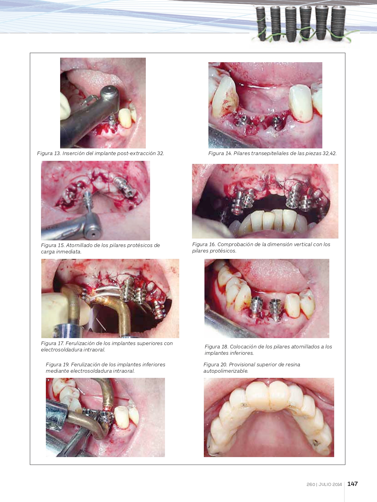 Rehabilitación-completa-maxilar-con-implantes-y-prótesis-de-carga-inmediata-con-electrosoldadura_page-0006