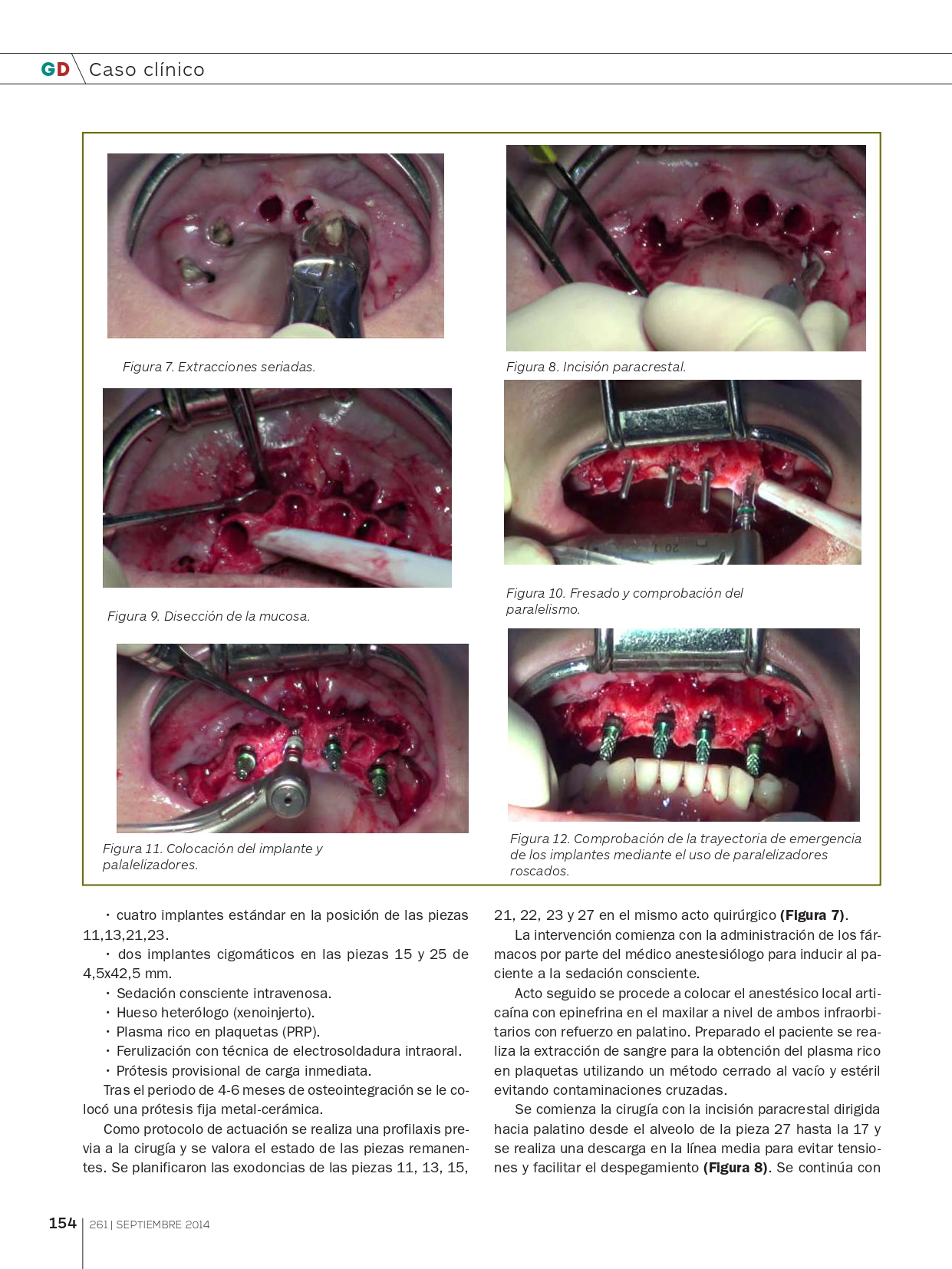 Rehabilitación-del-Maxilar-superior-con-implantes-Cigomáticos_page-0005