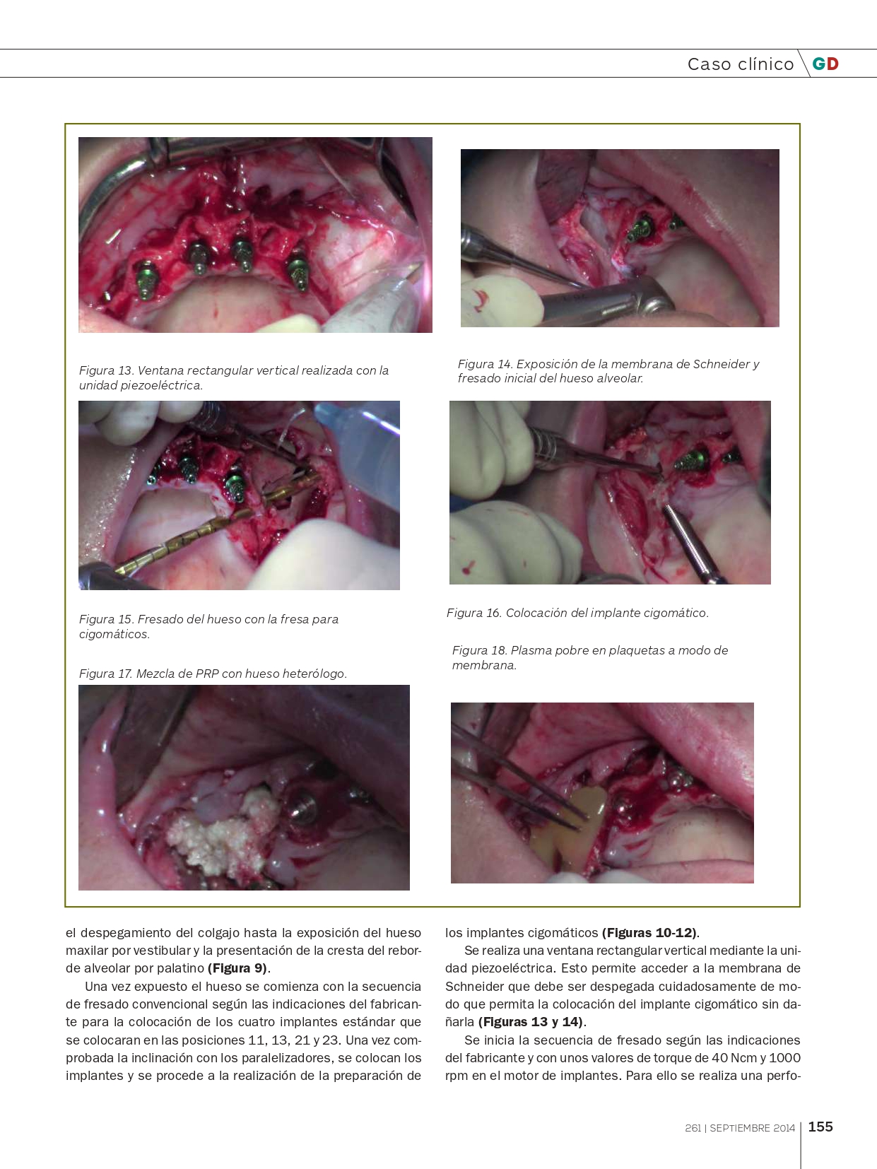 Rehabilitación-del-Maxilar-superior-con-implantes-Cigomáticos_page-0006