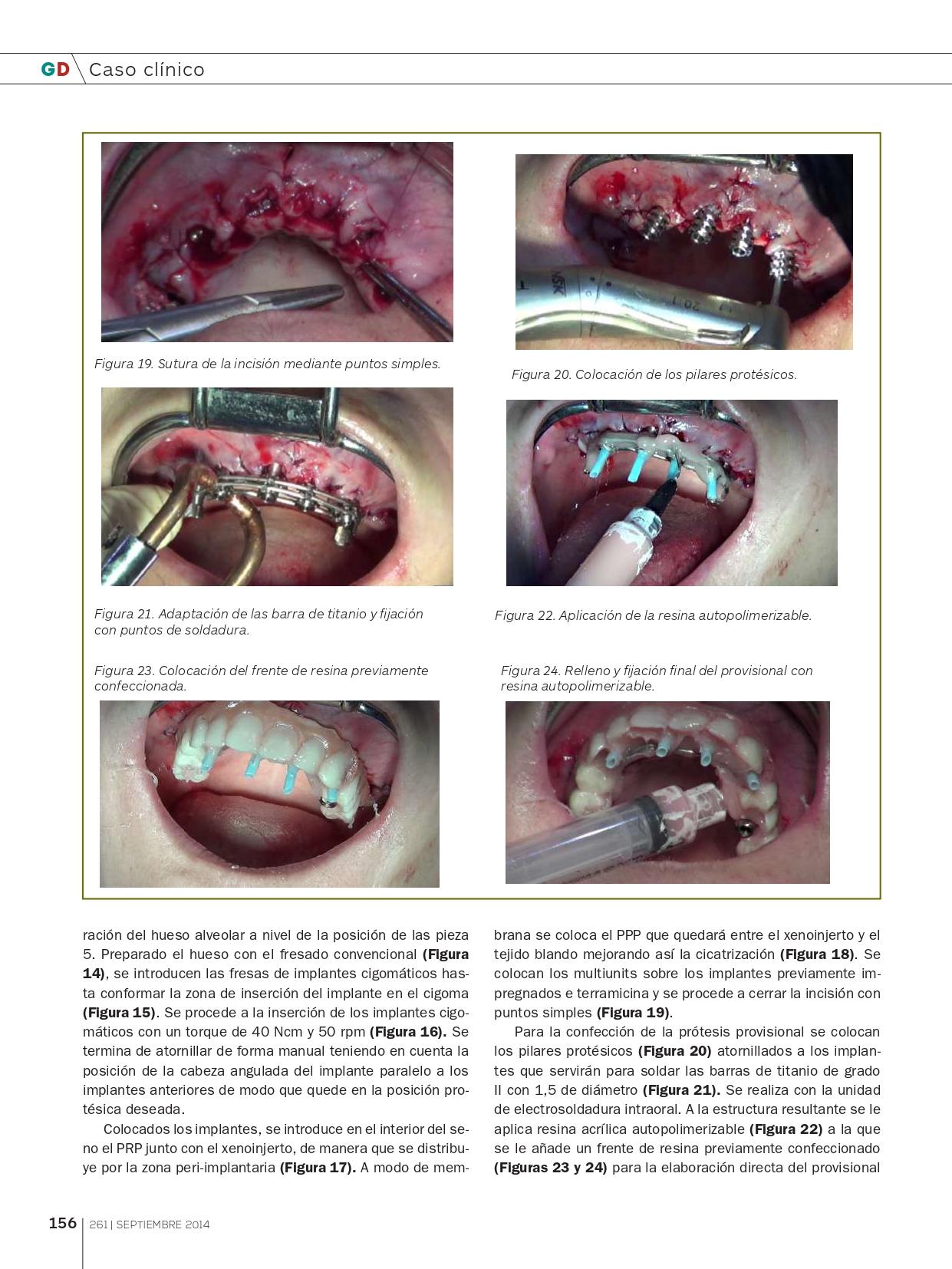 Rehabilitación-del-Maxilar-superior-con-implantes-Cigomáticos_page-0007