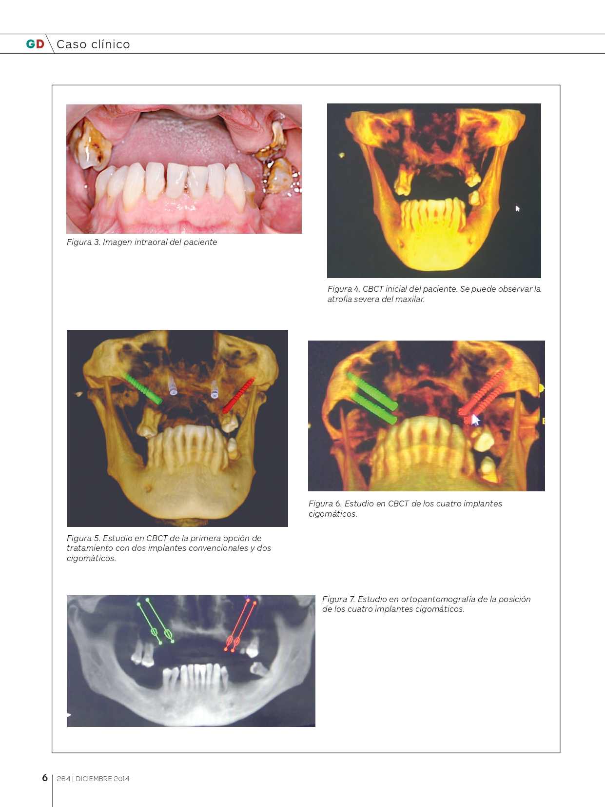 Rehabilitación-maxilar-completa-con-reabsorción-ósea-mediante-4-implantes-cigomáticos_page-0004