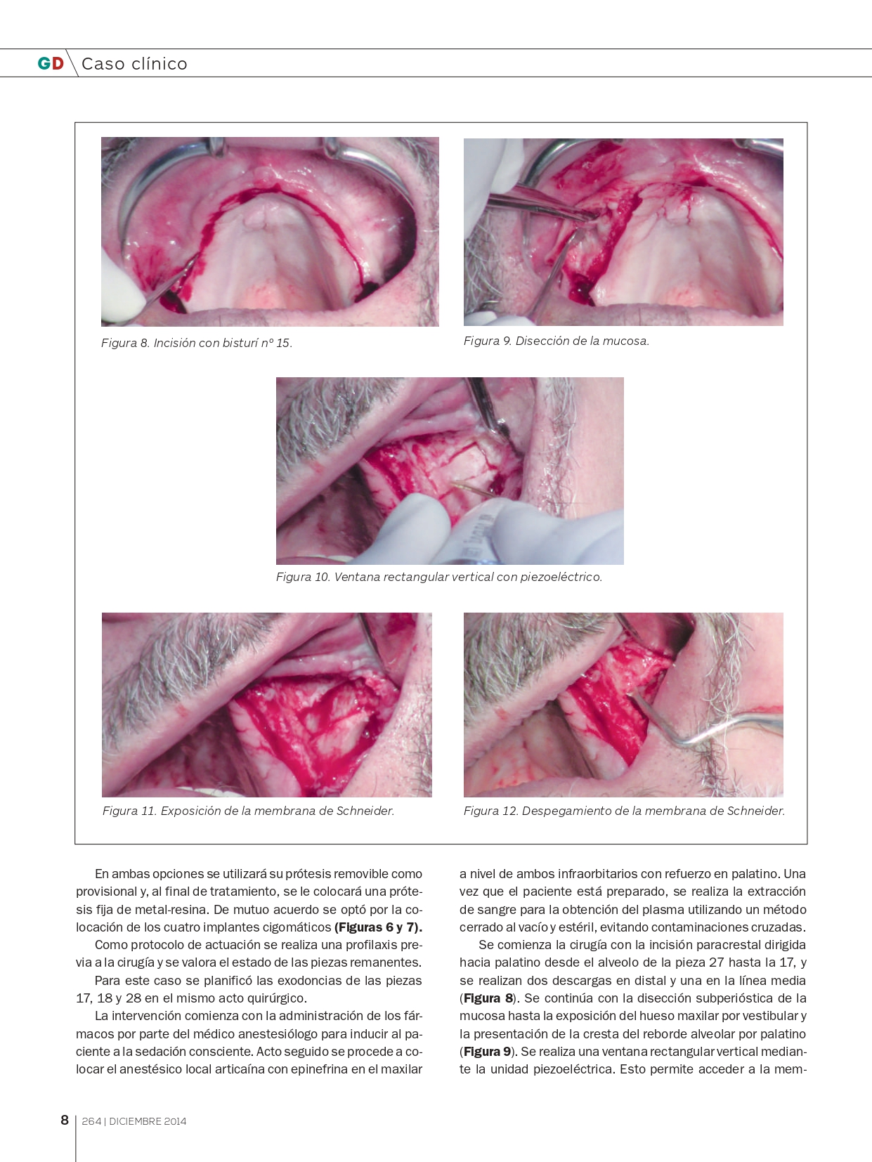 Rehabilitación-maxilar-completa-con-reabsorción-ósea-mediante-4-implantes-cigomáticos_page-0005