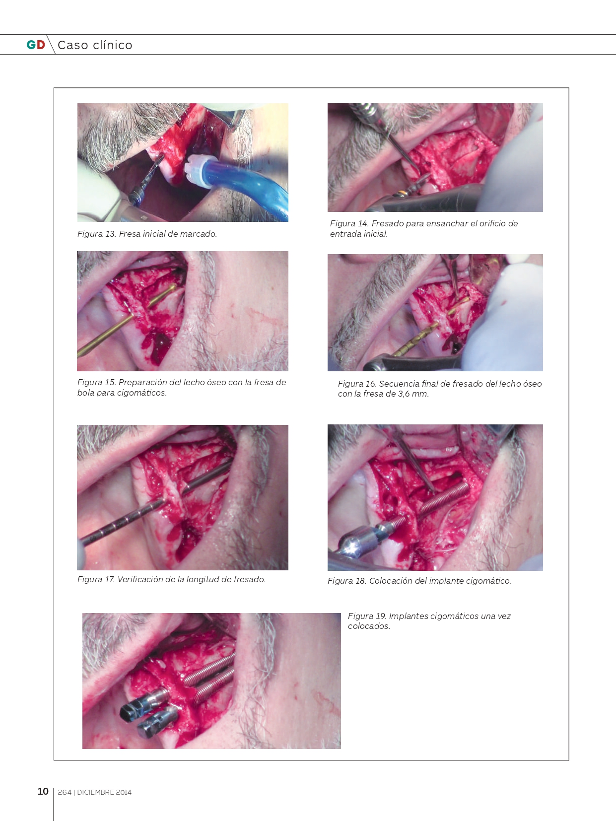 Rehabilitación-maxilar-completa-con-reabsorción-ósea-mediante-4-implantes-cigomáticos_page-0006