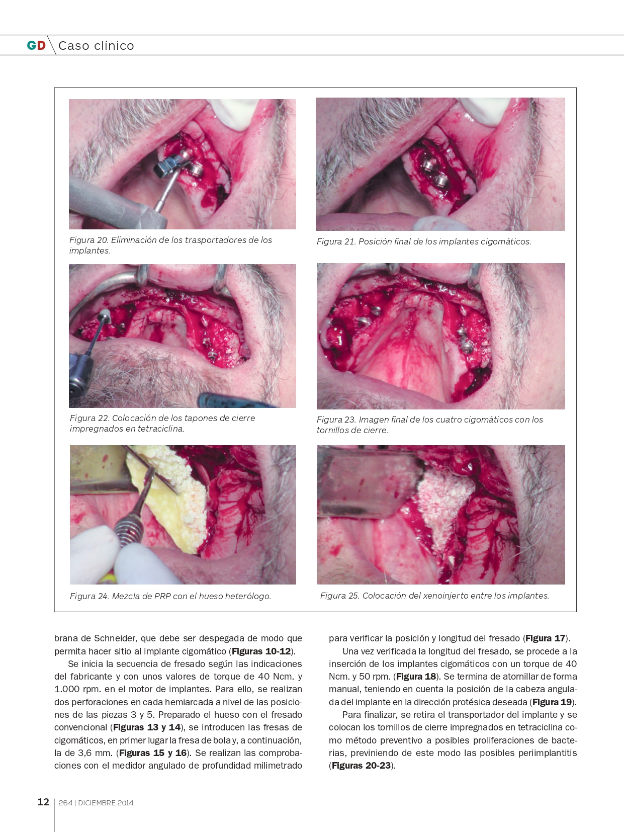 Rehabilitación-maxilar-completa-con-reabsorción-ósea-mediante-4-implantes-cigomáticos_page-0007