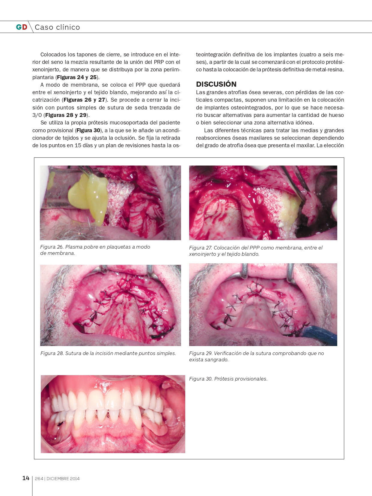 Rehabilitación-maxilar-completa-con-reabsorción-ósea-mediante-4-implantes-cigomáticos_page-0008