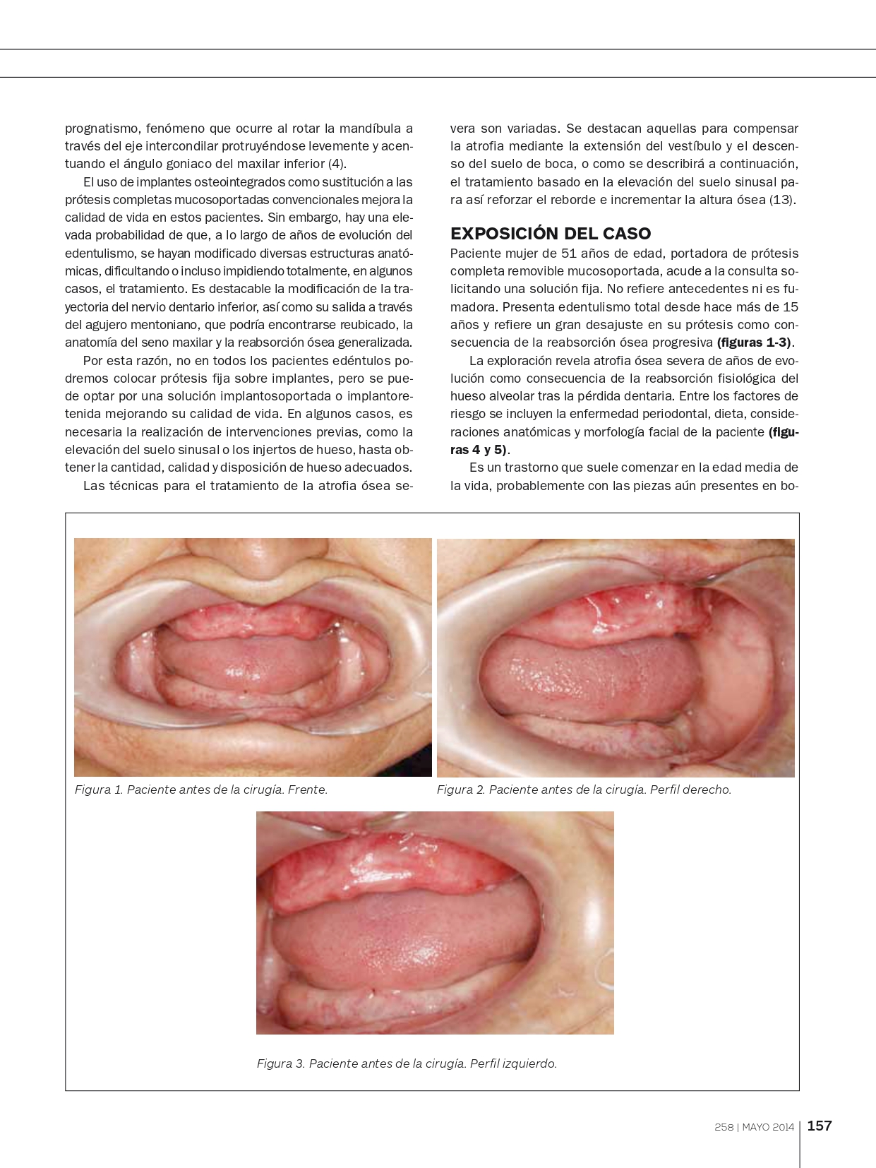 Tratamiento-con-implantes-y-elevación-de-seno-abierta_page-0002