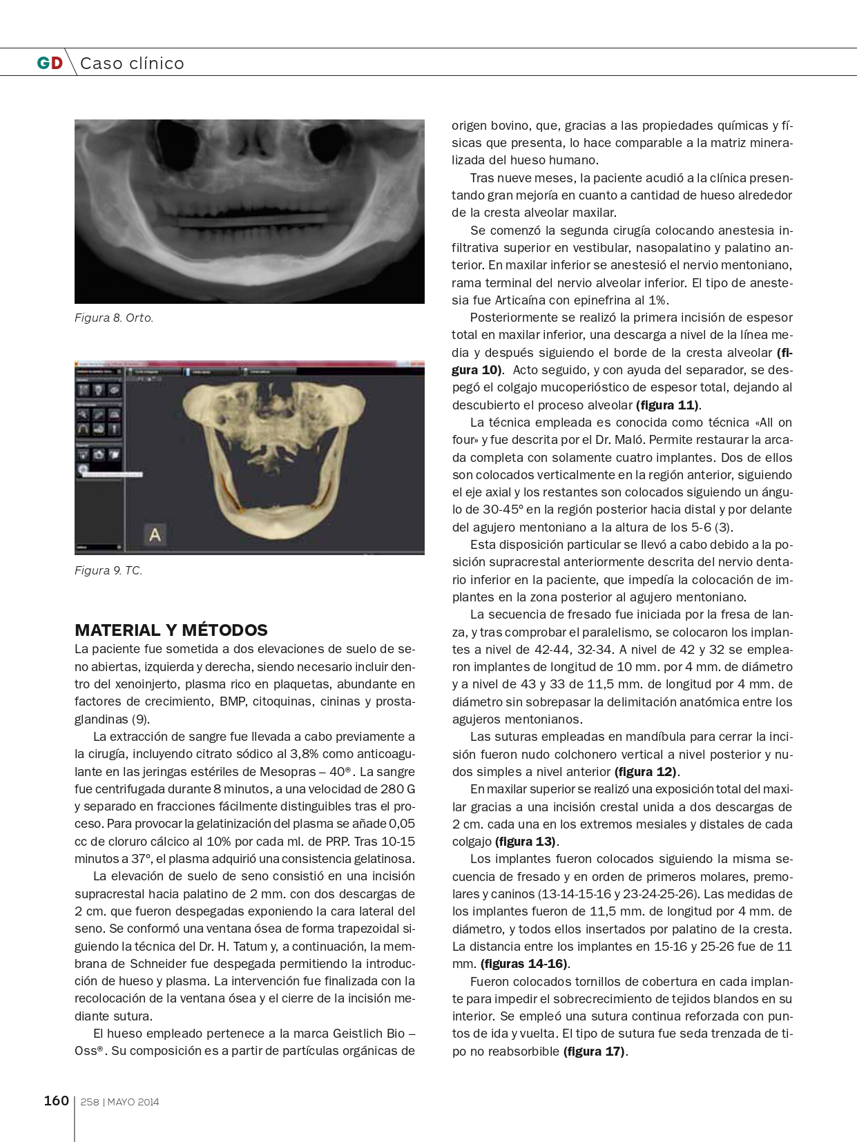 Tratamiento-con-implantes-y-elevación-de-seno-abierta_page-0005