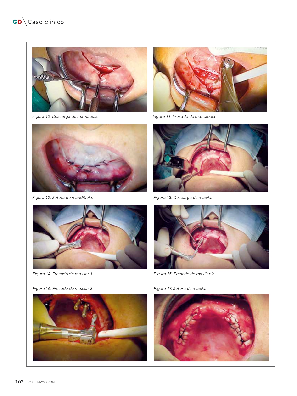 Tratamiento-con-implantes-y-elevación-de-seno-abierta_page-0006